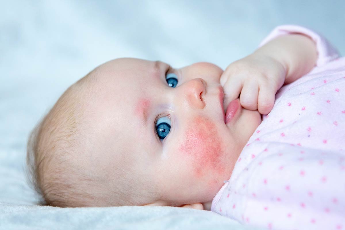 Roséole chez les bébés : Symptômes et traitements